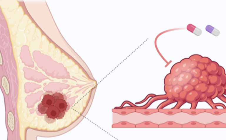 Unige breast Cancer