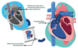 HUG - Transplantation
