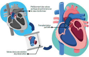 HUG - Transplantation